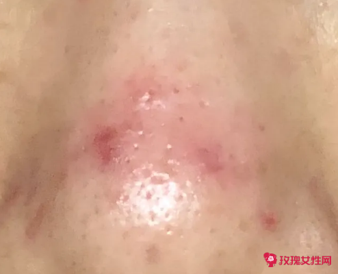 鼻子旁长痘了怎么办